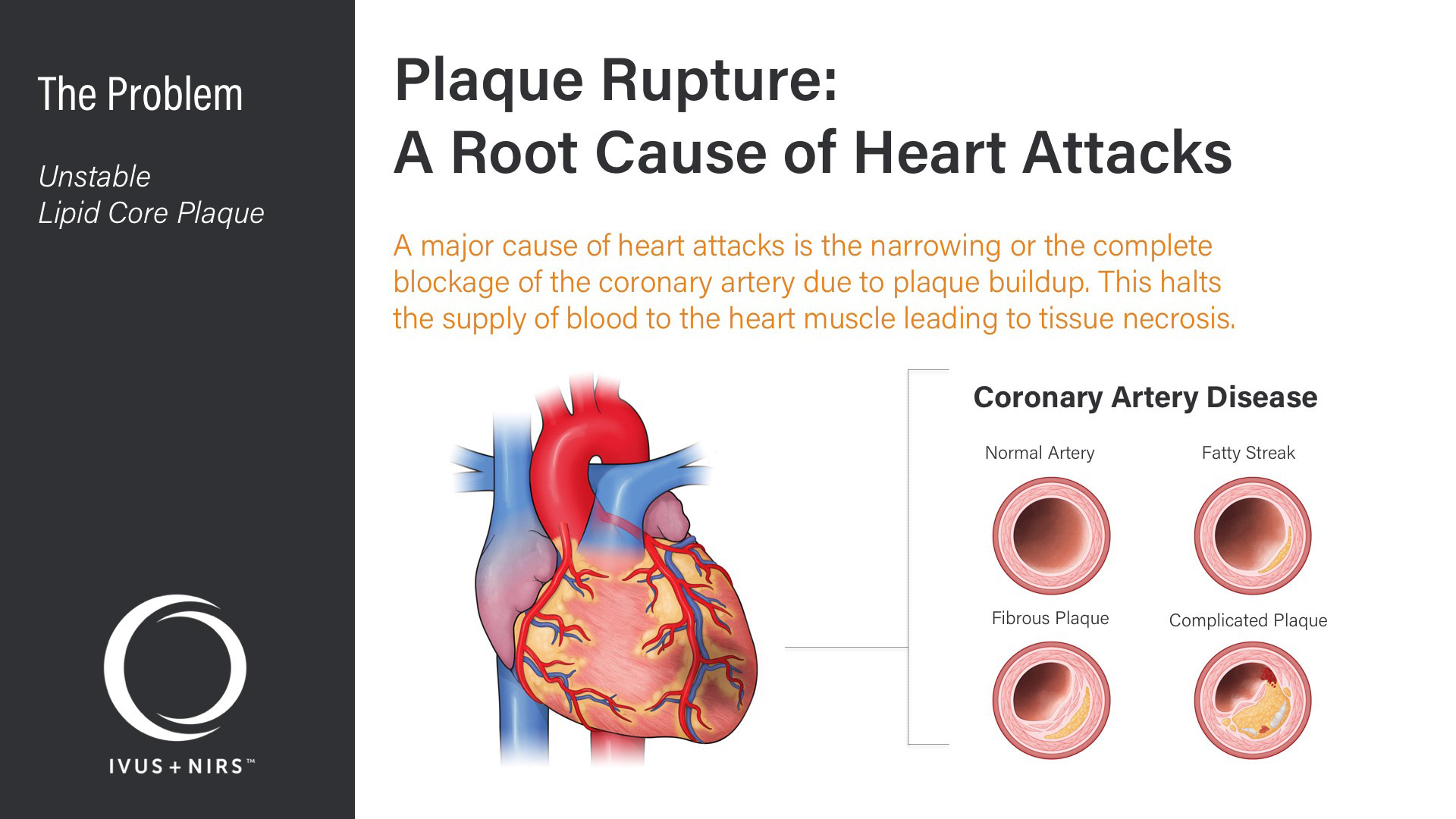 Infraredx Corporate Deck - Problem - Plaque Rupture: A Root Cause of Heart Attacks - Medical Illustrations of Heart & Coronary Artery Disease